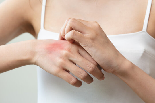 Dermatology, asian young woman reaction from atopic, insect bites on her arm, hand in scratching itchy red spot or rash of skin. Healthcare, treatment of beauty.