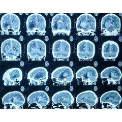 CT scan of brain, Intraventricular hemangioma with adjoining periventricular seepages and...