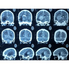 CT scan of brain, Intraventricular hemangioma with adjoining periventricular seepages and herniation.