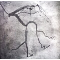 Coronary angiogram of left coronary artery during cardiac catheterization with contrast dye....