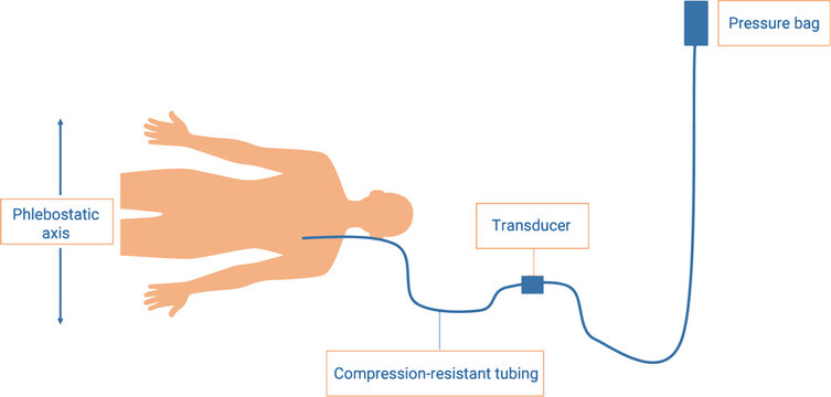 Measuring central venous pressure in humans. CVP is measured through a pressure transducer connected to a central venous catheter in the thoracic central veins (internal jugular or subclavian). 