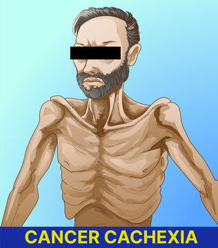 Cachexia. Cancer Cachexia. A human body with serious health problems. Educational illustration. Healthcare illustration. Vector illustration. 