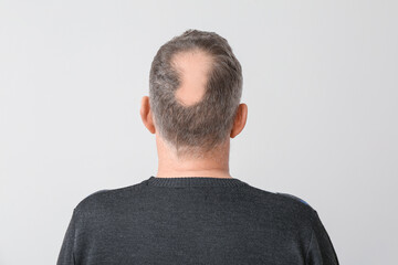 Senior man with hair loss problem on light background
