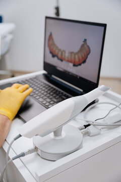 Advanced 3D dental scanner with digital teeth model displayed on a laptop in a dental clinic