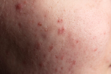 Fototapeta premium Dermatological acne. Skin texture background. Closeup acne pimple. Problem skincare. Pimples, acne, pores, scars. Natural skin. Skin care concept. Acne treatment. Pimples on skin.
