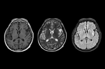 MRI  brain scan  axial T1W ,T2W and Flair for detect  Brain  diseases sush as stroke disease, Brain tumors and Infections.