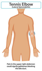 Fototapeta premium Tennis Elbow Medical Illustration