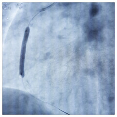 Coronary angiogram of right coronary artery during cardiac catheterization with dye. PTCA, or...