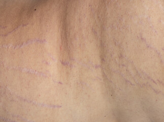 Fototapeta premium A person's back with a scar on it