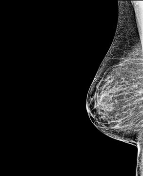 Contrast-enhanced digital mammography