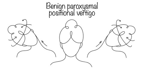 Benign paroxysmal positional vertigo