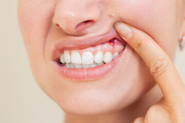 Close-up young Caucasian woman showing her gums on the upper jaw, suffering from gum inflammation,...