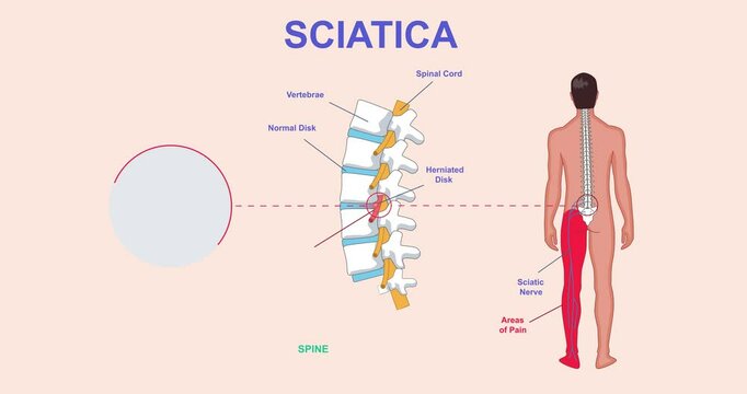 Infograhics with sciatica. Moving banner with mans spine. Healthcare and medicine. Orthopedics and correct posture. Anatomy and biology. Medical educational materials. Cartoon flat animated graphics