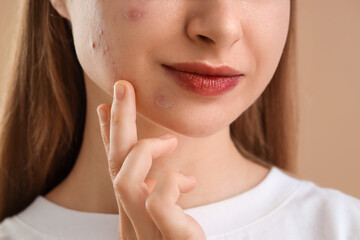 Young woman with acne problem and applied pimple patches on beige background, closeup