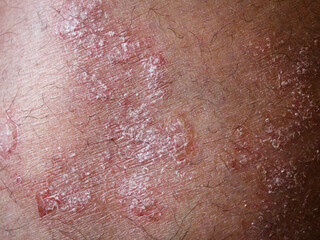 Fototapeta premium macro close-up of eczema skin flare up dermatology background