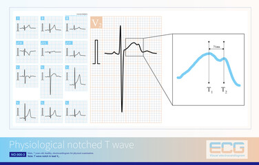 Under normal circumstances, notch T waves are more common in leads V2-V3 and are caused by asynchronous local ventricular repolarization.