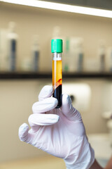 Medical professional's gloved hand holding  test tube of blood plasma showcasing vibrant, distinct colors for laboratory testing and aesthetic procedures