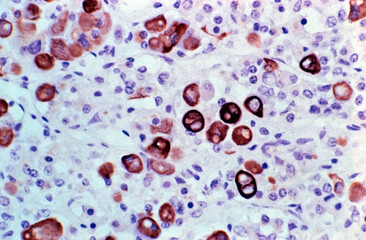 Pituitary gland. Crooke change. Ubiquitin