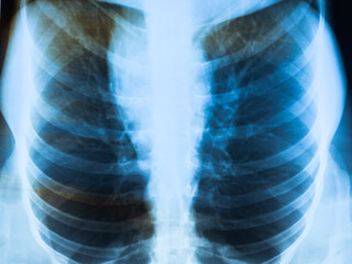 Fluorography, X-ray. Human lung cancer. Medical treatment concept.