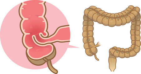 腸重積症、Intussusception、イラスト