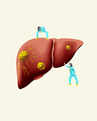 Contemporary art collage. Detailed illustration of liver with highlighted problem areas, depicting health issues, diagnostics, and medical treatment. Concept of health insurance, pharmacy,
