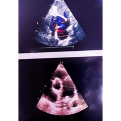 Color Doppler echocardiography, Lutembacher syndrome, TR with pulmonary hypertension.