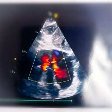 Color Doppler echocardiography, Lutembacher syndrome, TR with pulmonary hypertension.