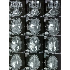 MRI scan of brain, Intraventricular hemangioma with adjoining periventricular seepages and...