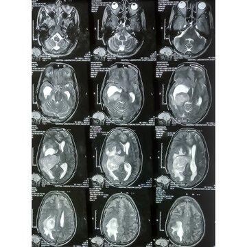 MRI scan of brain, Intraventricular hemangioma with adjoining periventricular seepages and herniation.