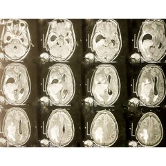 MRI scan of brain, Intraventricular hemangioma with adjoining periventricular seepages and...