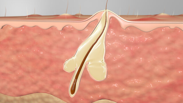 Hair Folicle Sebacious Gland Infected Pimple
