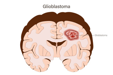Glioblastoma. Gliomas. Brain tumors vector. Brain cancer. Human brain structure.