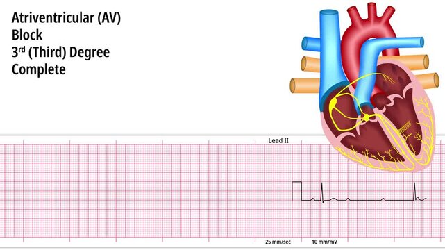 Third Degree Atrioventricular Block - Total AV Block - ECG and Heart Conduction - Electrocardiogram Medical Animation