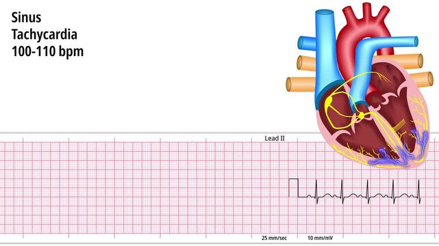Sinus Tachycardia - ECG and Heart Conduction - Electrocardiogram Medical Animation