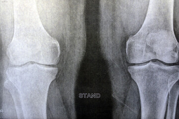 Plain x-ray of the knee showing apparent joint osteoarthritis according to Kellgren and Lawrence system for classification of osteoarthritis with definite osteophytes and join space narrowing