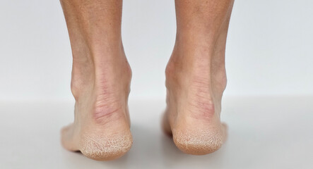 The heel of the foot with bad skin is covered with cracks concept