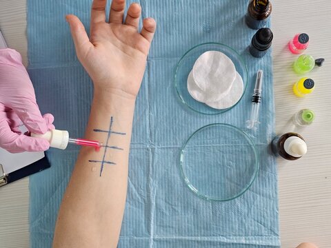 Skin allergy testing process in a dermatology clinic with description of allergens.