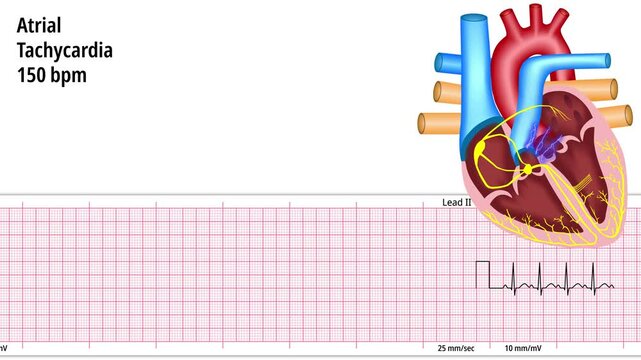 Atrial Tachycardia 150 bpm - Supraventricular - ECG and Heart Conduction - Electrocardiogram Medical Animation
