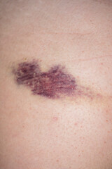 Bruise on body. Hematoma. Closeup Bruise on body. Close up on a bruise. Violence, victim. Bruise wounded skin texture.