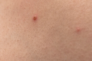 Pimple closeup. Skin texture. Closeup acne skin. Treatment for skin. Problem skincare. Acne...