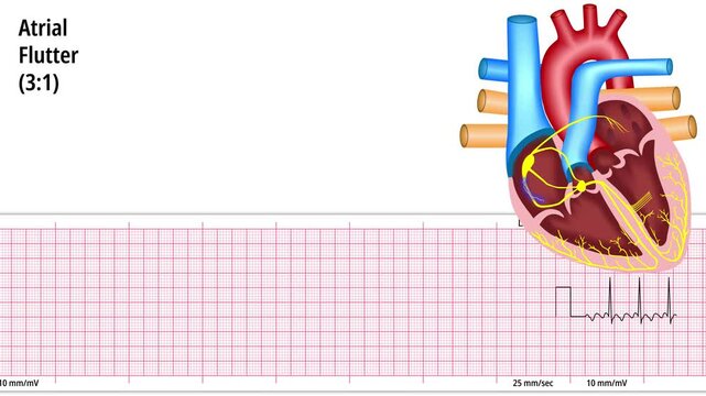 Atrial Flutter 3:1- ECG and Heart Conduction - Electrocardiogram Medical Animation