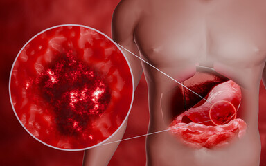 Gastric cancer. Noncommunicable diseases or NCDs. Gastrointestinal ailments from eating junk food. Stomach pain, stomach ulcers from acid reflux. 3D Rendering