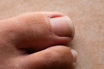 Close-up of dry and cracked big toe showing signs of dehydration and neglect