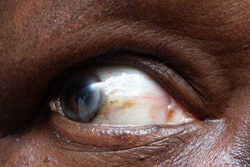 Pterygium affecting human eye showing blood vessels and pupil