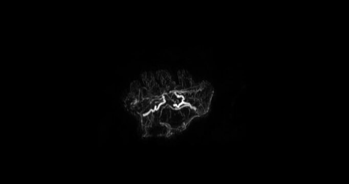 MRA of Hand with Hypothenar Mass:
A clear MRA scan of the hand reveals a strongly-enhancing vascular mass in the hypothenar area of the palm, supporting vascular diagnosis and management.