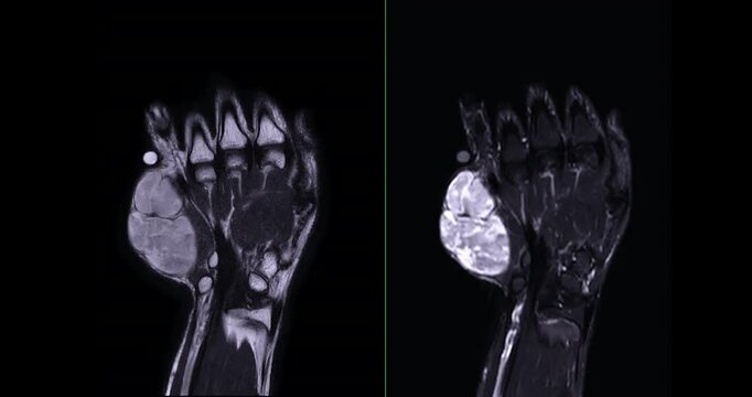MRI Hand footage Showing Hypothenar Mass, a strongly-enhancing mass in the hypothenar region of the palm, providing detailed imaging for precise diagnosis and medical evaluation.