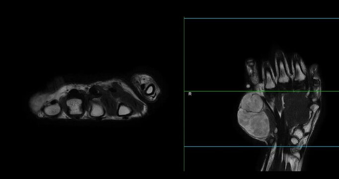 MRI Hand footage Showing Hypothenar Mass, a strongly-enhancing mass in the hypothenar region of the palm, providing detailed imaging for precise diagnosis and medical evaluation.