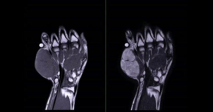 MRI Hand footage Showing Hypothenar Mass, a strongly-enhancing mass in the hypothenar region of the palm, providing detailed imaging for precise diagnosis and medical evaluation.