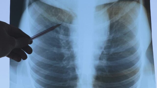 Doctor learning Fluorography, X-ray. Human lung cancer. Medical treatment concept. 4k footage.