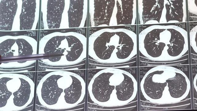 Doctor learning Chest CT image. Lung parenchyma. Diagnostic diseases of lungs. Close up, 4k footage.